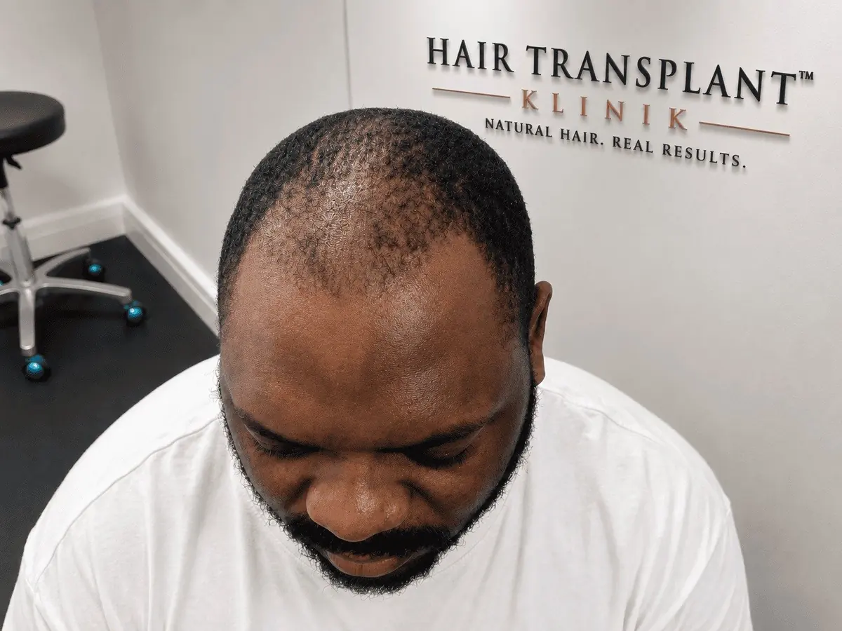 Afro hair transplant for men at Hair Transplant Klinik