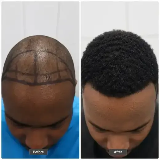Afro hair transplant before and after, real patient