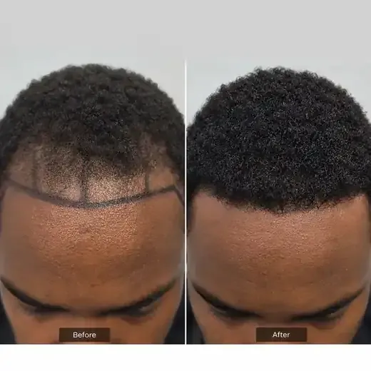 Afro hair transplant before and after, real patient