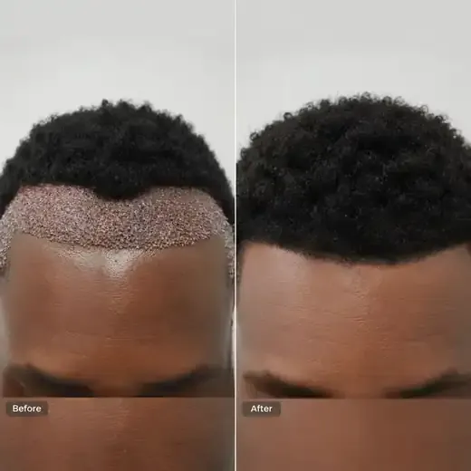 Afro hair transplant before and after, real patient