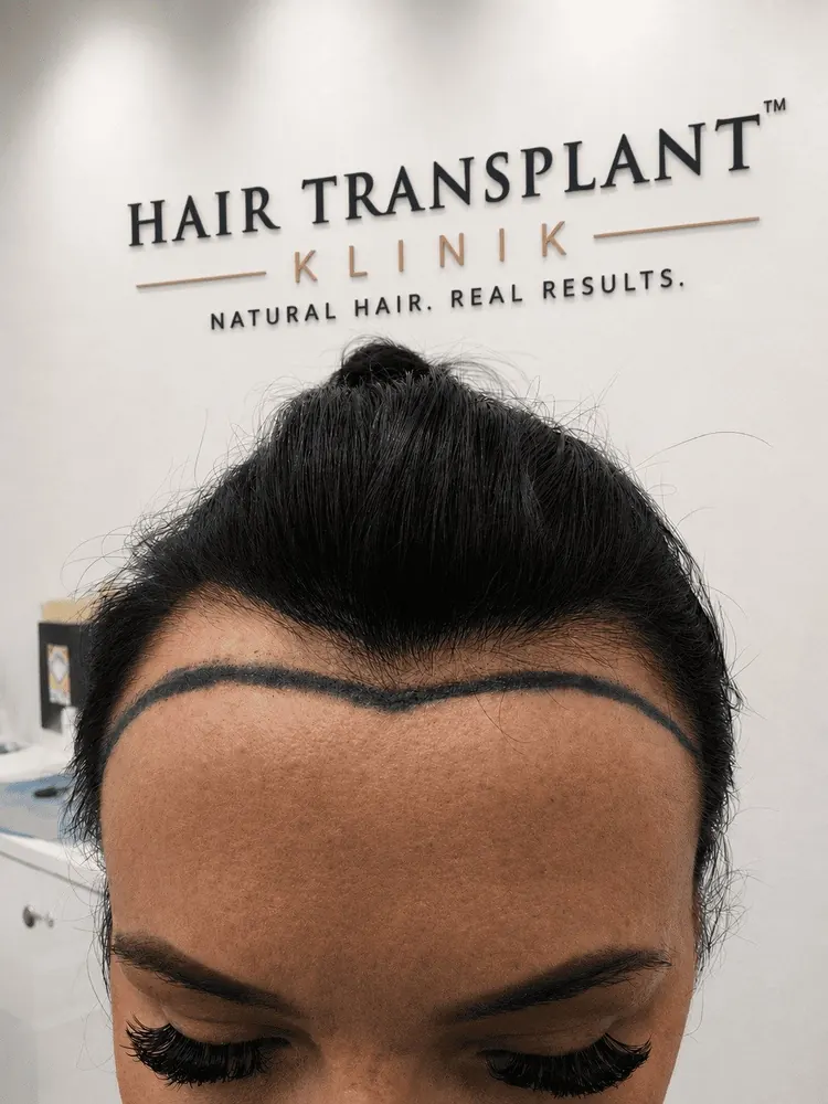 Hair transplant (FUE) for women at Hair Transplant Klinik