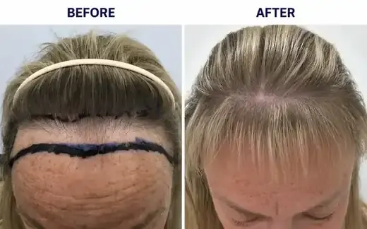 FUE hair transplant before and after, real female patient