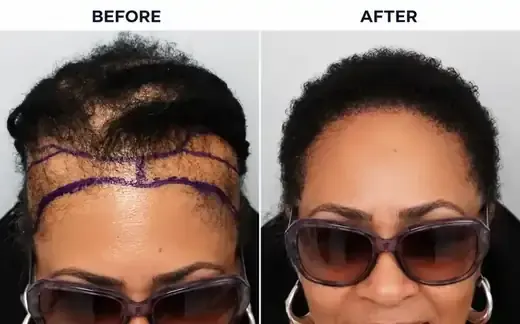 FUE hair transplant before and after, real female patient