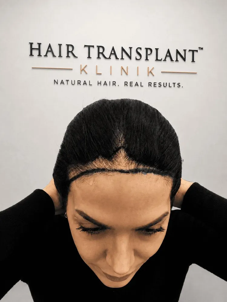 Un-shaven hair transplant for women at Hair Transplant Klinik