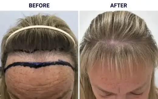 Un-shaven FUE hair transplant before and after, real female patient