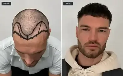 Hair transplant before and after result