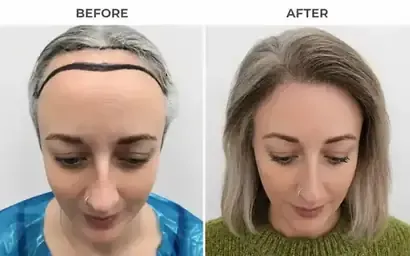 Hair transplant before and after result