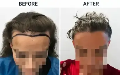 Hair transplant before and after result