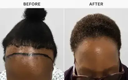 Hair transplant before and after result