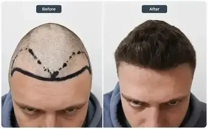 Hair transplant before and after result