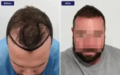 Hair transplant before and after result