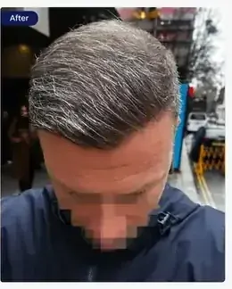 After FUE hairline transplant, natural restored hairline