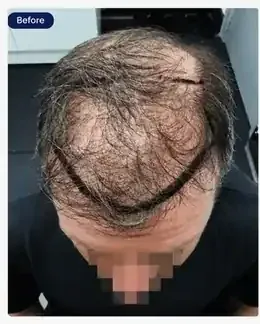 Before FUE hairline transplant, receding hairline