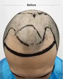 Before Crown Restoration