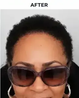 After Female Hairline Restoration
