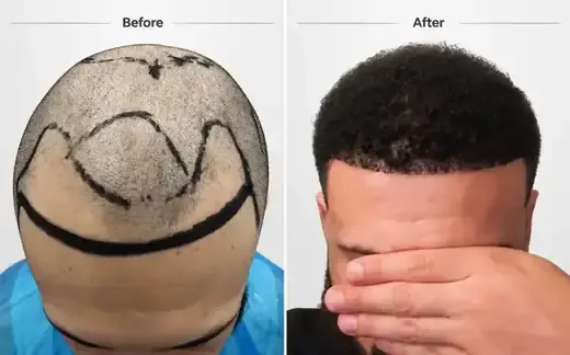 FUE hair transplant before and after, real patient