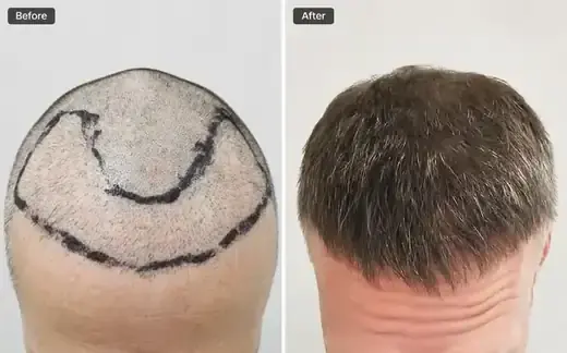 FUE hair transplant before and after, real patient