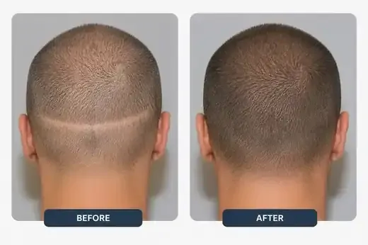 Hair transplant scar concealment before and after, real patient
