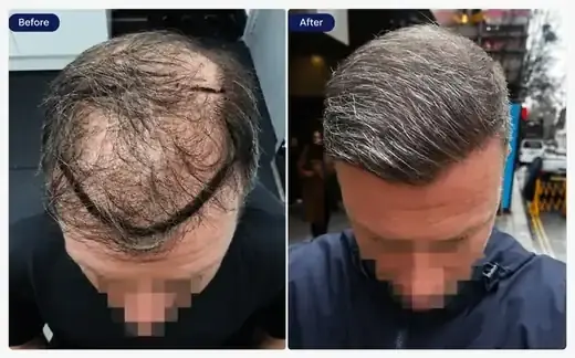 Un-shaven FUE hair transplant before and after, real patient