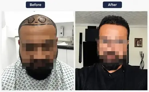 Un-shaven FUE hair transplant before and after, real patient