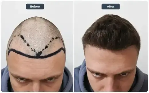 Un-shaven FUE hair transplant before and after, real patient